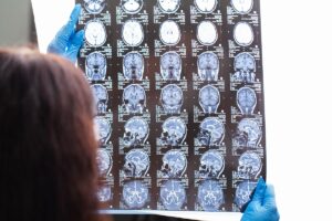 Protecting Your Legal Rights After a Traumatic Brain Injury